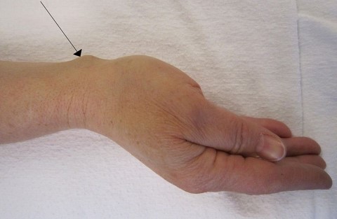 손목 물혹, 손목 결절종 치료법 중 힘으로 터트리기!!! 좋은 방법일까? : 네이버 블로그