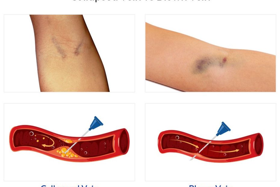 What Is A Collapsed Vein? » Ask Our Doctors (By Journeypure)