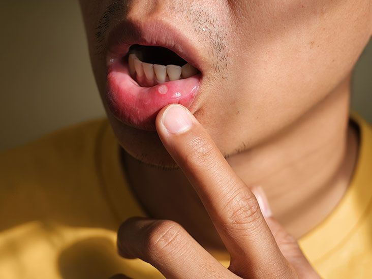 Mouth Ulcer: Causes, Symptoms, Diagnosis, And Treatment