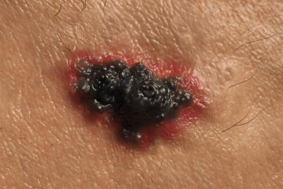 Stage 4 Melanoma: Survival Rate, Pictures, And Treatment