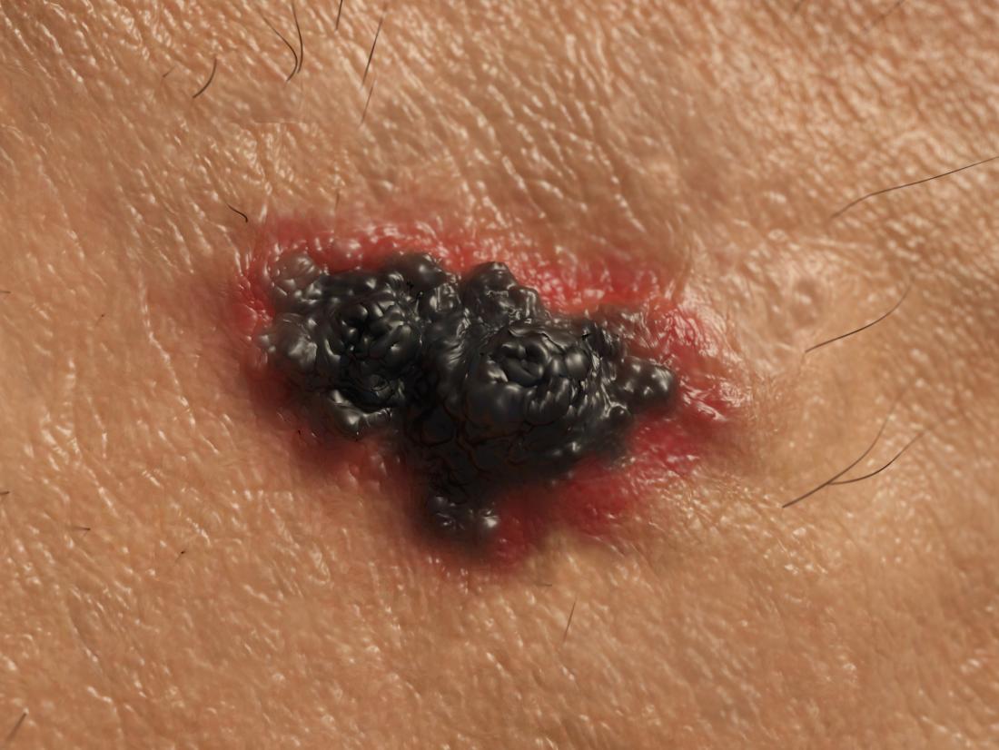Stage 4 Melanoma: Survival Rate, Pictures, And Treatment